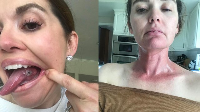 “I Can Never French Kiss My Husband Again After Having Half of My Tongue Removed and Replaced With My Leg Muscle”