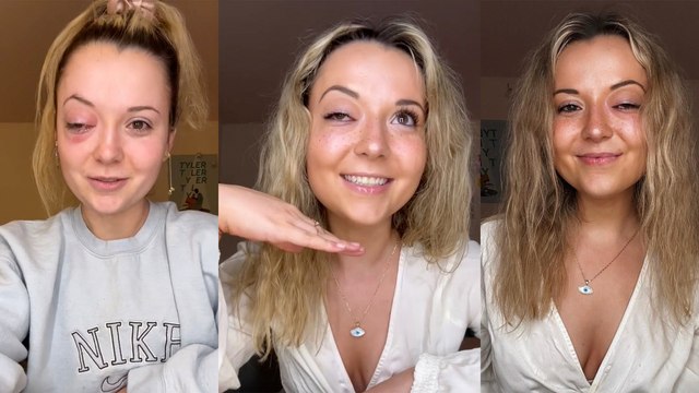 “I Had Stents Implanted in My Brain When I Lost Vision in My Right Eye After a Mystery Illness”