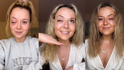 “I Had Stents Implanted in My Brain When I Lost Vision in My Right Eye After a Mystery Illness”