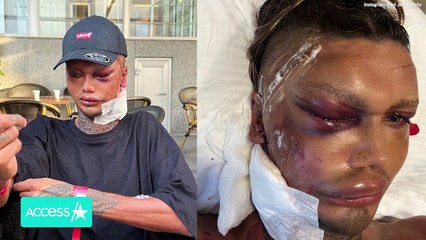 TikTok Star Levi Jed Murphy Reveals NEW FACE After 5 Plastic Surgeries