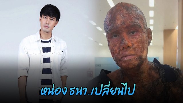 หน่อง ธนา ทำแตกตื่น ถูกเผาทั้งเป็น แผลไหม้ทั่วตัว ยิ่งซูมยิ่งขนลุก