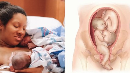 Twin Pregnancy Me Normal Delivery Possible है या नहीं, EXPERT ADVICE | Boldsky