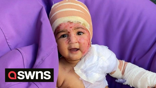 My toddler was burned by my hot coffee when it fell on her face – she was left looking like a Teletubby