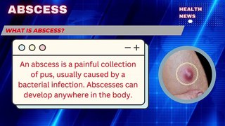 ✅Skin Abscess ✅ Causes, Symptoms, Treatment, Prevention #abscess #skinabscess #internamabscess