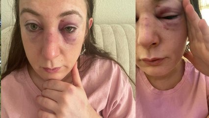 Eski sevgilisi yüzüne 9 defa kafa attı