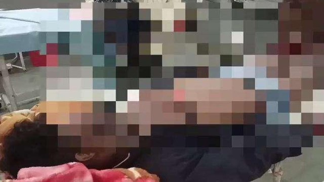 बैतूल: बाइक चालक दुर्घटना का हुआ शिकार, शरीर पर कई जगह आई गंभीर चोट