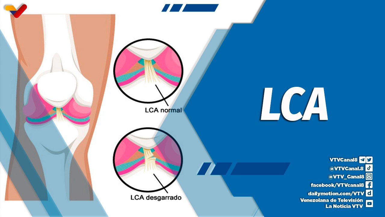 Actitud Saludable | ¿Qué es la lesión del ligamento cruzado anterior?