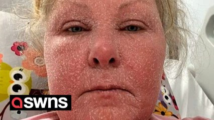 Woman lost all her hair after through severe Topical Steroid withdrawal after ditching steroid creams