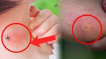Dengue Mosquito Bite Looks Like | Dengue Machar Katne Ke Nishan Kaise Hote Hai | Boldsky