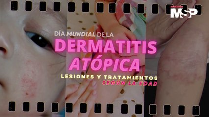 Día Mundial de la Sepsis - ¿Qué es y cómo funciona?