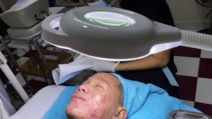 Big Cystic Acne Blackheads Extraction Blackheads & Milia, Whiteheads Removal Pimple Popping
