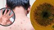Chickenpox New Variant Clade 9 से India में कितना खतरा, क्या है Clade 9 Symptoms और Precautions