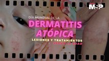 Día Mundial de la Dermatitis Atópica: Lesiones y tratamientos según la edad