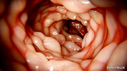 Malattia di Crohn, arriva nuova soluzione terapeutica "su misura"