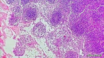 Linfoma follicolare, AIFA approva mosunetuzumab