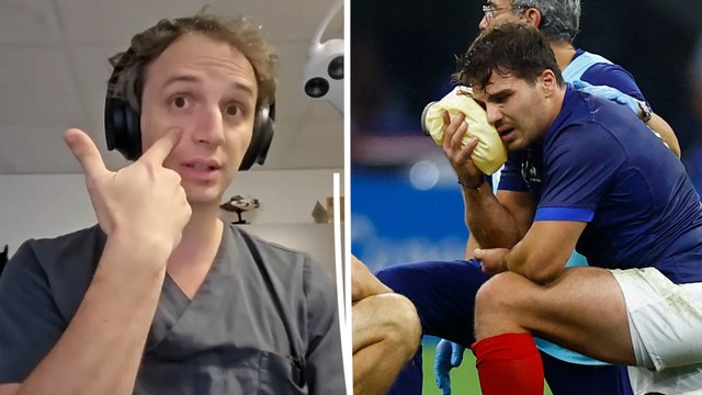Antoine Dupont blessé : un chirurgien maxillo-facial décrypte les scénarios après sa fracture