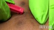 Removing Embedded Hairs From A Brazilian Laser Hair Removal #Showoff​ - HueVine