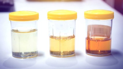 What Your Urine Color Says About Your Health