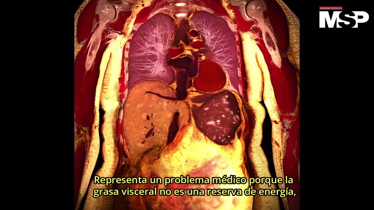 Qué es la obesidad y por qué es una enfermedad