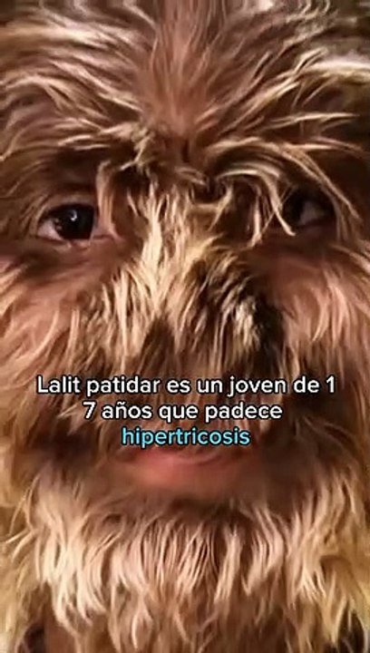 La enfermedad que lo convierte en hombre lobo