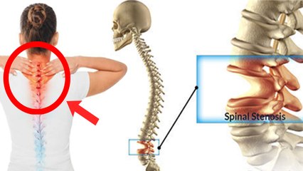 रीढ़ की हड्डी में गैप क्यों होता है | Spinal Cord Gap Symptoms in Hindi | Rid Ki Haddi Me Gap Hona