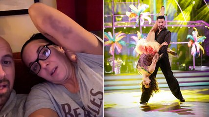 Strictly’s Amanda Abbington reveals bruises after dancing with injury