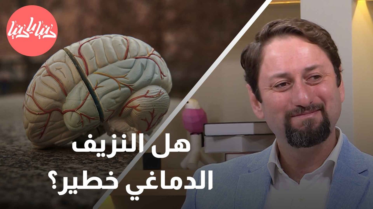 النزيف الدماغي كيف يحدث وما هي أسبابه؟