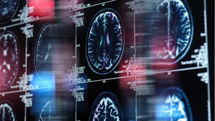 Doctors find 3cm long needle in woman's brain, lodged for 80 years