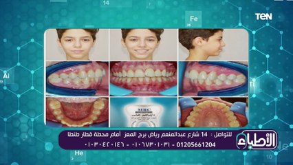 تعرف على أنواع حالات التقويم خلال مرحلة الأسنان المختلطةتقويم خلال مرحلة الأسنان المختلطة