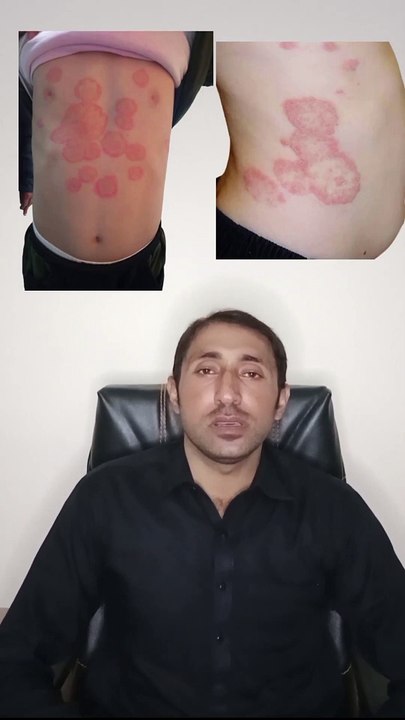 Tinea corporis treatment _ terbisil cream uses _ fungal infection treatment _ how to treat fungus