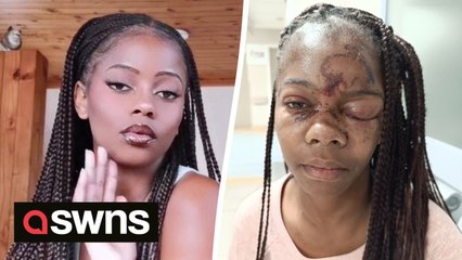 “I ignored a cat-caller so he threw a brick across my face – I lost my eye and there is still no arrest"