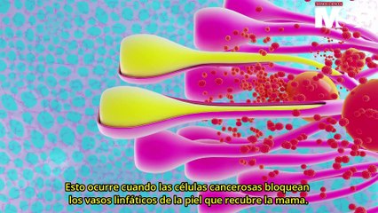 Supervivencia por cáncer de mama inflamatorio en mujeres de Puerto Rico - #MSP