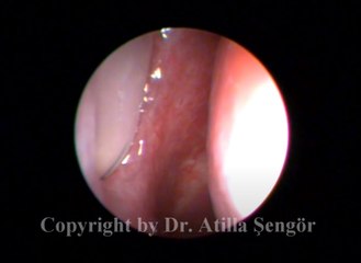 Circulation of mucus secretion through the accessory ostium as a cause of postnasal drip - Geniz akıntısı sebebi olarak aksesuar ostium