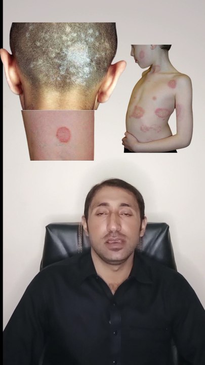 Contact dermatitis  | contagious disease  |  How to spread fungal infection