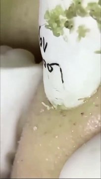 ASMR relaxing Black Heads removal on nose Satisfying #blackheads #asmr #satisfying