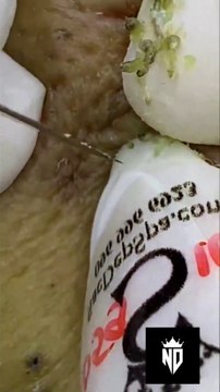 ASMR relaxing Black Heads removal satisfying #blackheads #asmr #satisfying