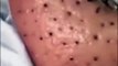 ASMR relaxing Black Heads remove Most satisfying  #blackheads #asmr #satisfying