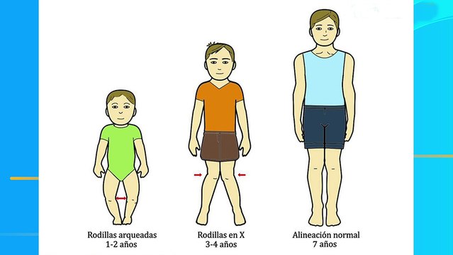 bd-caminar-extraño-en-niños-causas-y-posibles-tratamientos-091023