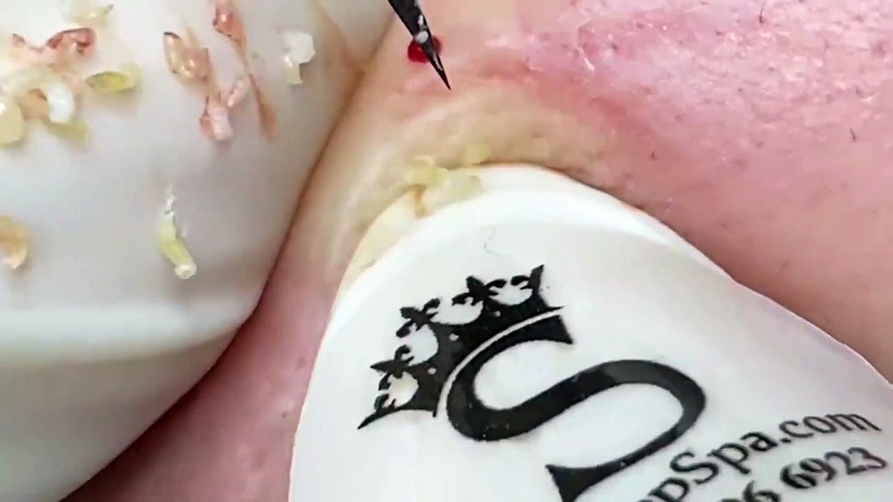 Blackheads and whiteheads remove Most satisfying ASMR relaxing #blackheads #asmr #satisfying 1