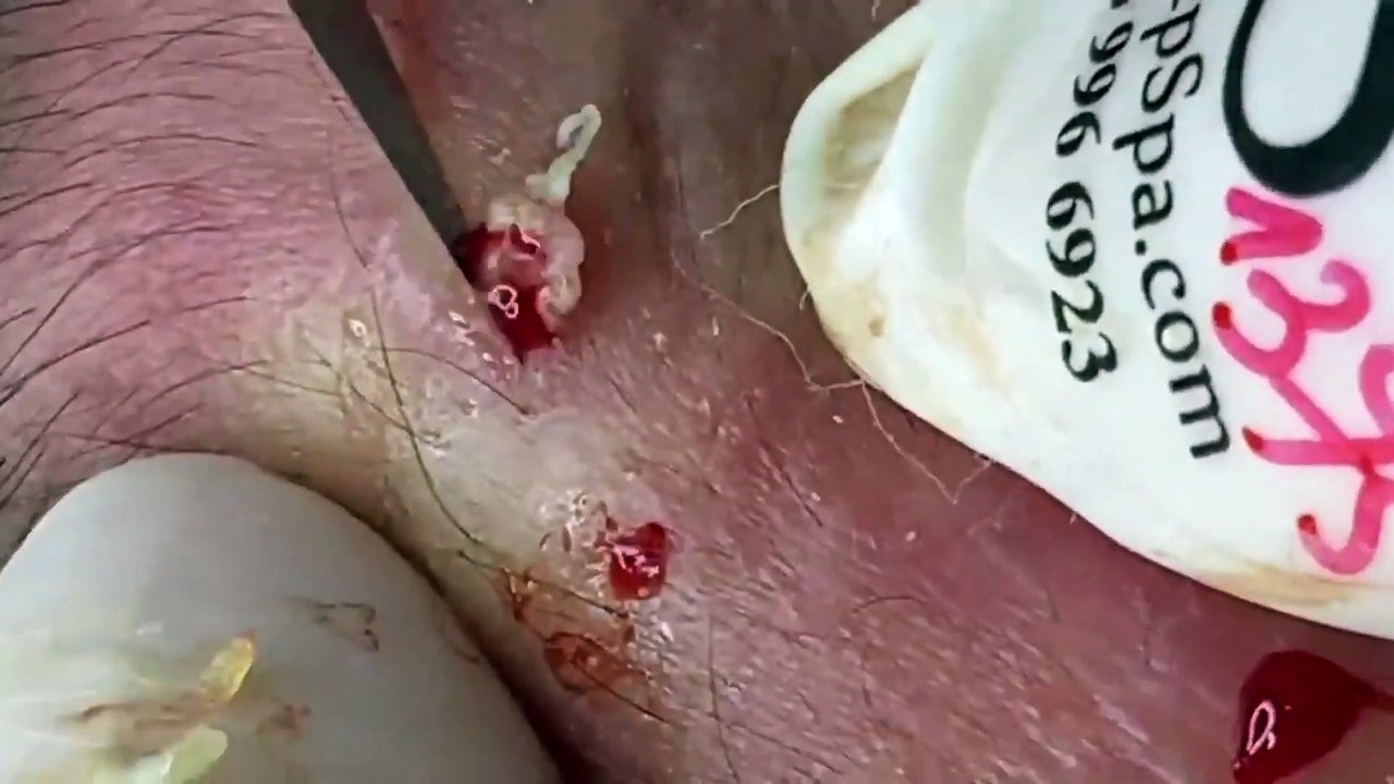 BLACKHEADS REMOVAL,  Blackhead Buster Say Goodbye to Pesky Blackheads! (3)