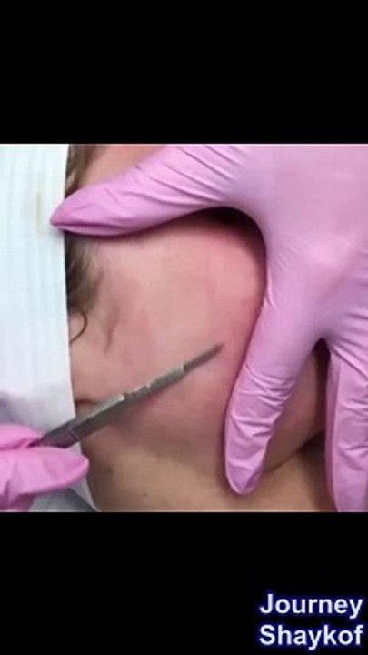 Try replacing conventional shampoos and conditioners with natural alternatives- If acne appears on the neck