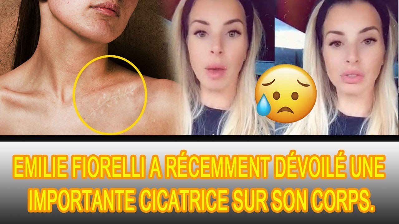 Emilie Fiorelli s'est confiée sur cette blessure douloureuse qu'elle a subie :