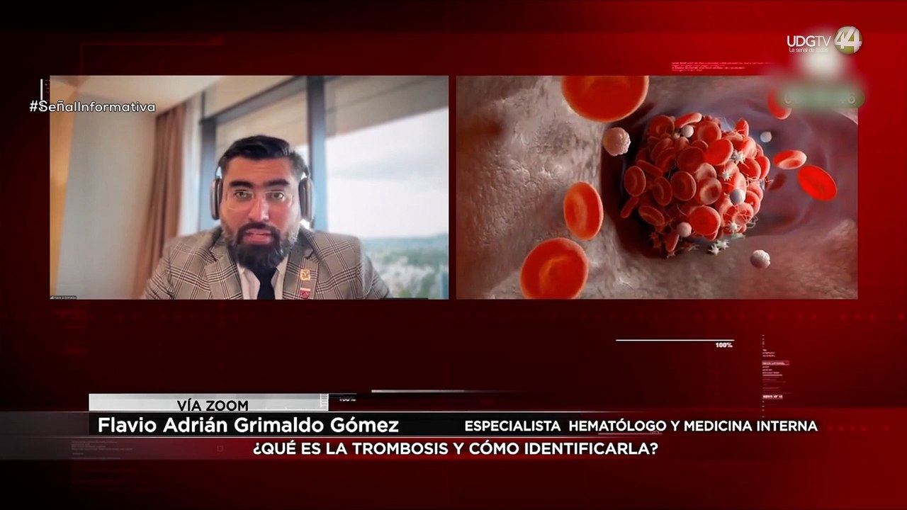 La trombosis: principal causa de muerte en hospital. puede evitarse, afirma especialista