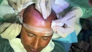 Must Watch Before Hair Transplant - Hair Transplant Complete Process and Final Results - Mubashir