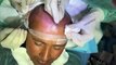 Must Watch Before Hair Transplant - Hair Transplant Complete Process and Final Results - Mubashir