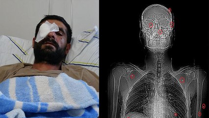 Pusu kuran hasımları av tüfeğiyle vurdu, bir gözünü kaybetti