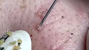 ASMR Blackhead Extraction Therapy: Deep Relaxation & Pore Cleansing!
