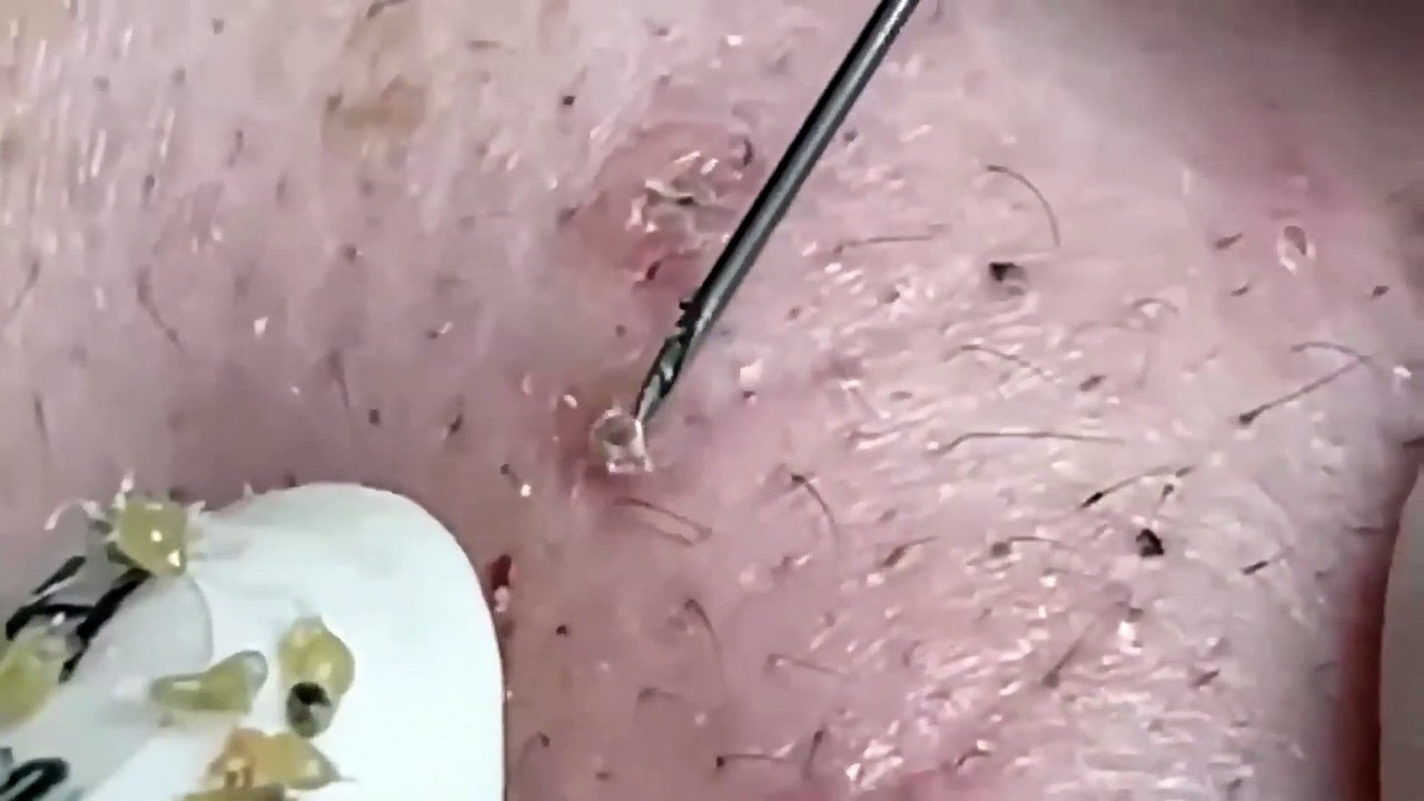ASMR Blackhead Extraction Therapy: Deep Relaxation & Pore Cleansing!