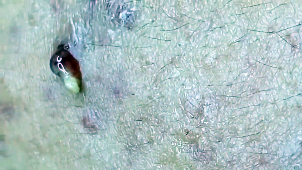 BLACKHEADS REMOVAL, Blackhead Buster Say Goodbye to Pesky Blackheads ...