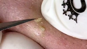 BLACKHEADS REMOVAL,  Blackhead Buster Say Goodbye to Pesky Blackheads!